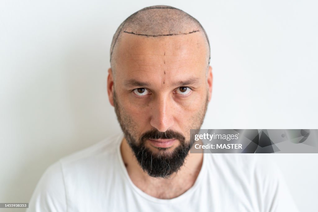 Portrait of markings on forehead before hair transplant surgery