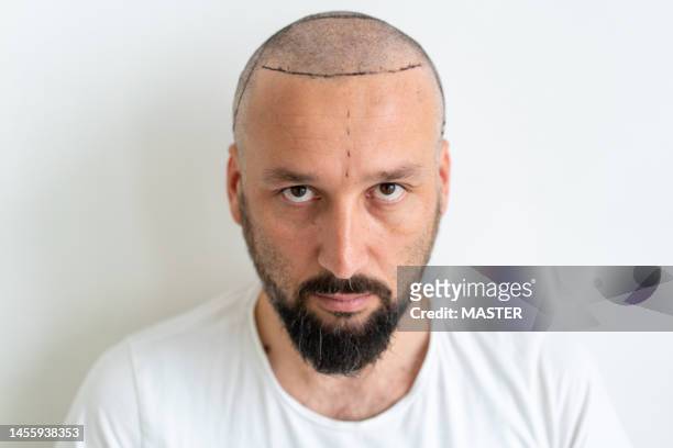 portrait of markings on forehead before hair transplant surgery - haartransplantation stock-fotos und bilder