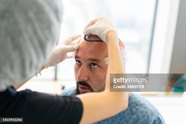 hair transplant surgery, the whole process in series - operating table stock pictures, royalty-free photos & images