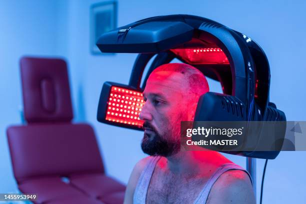 infrared light before hair transplant procedure - balding foto e immagini stock