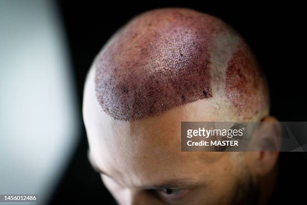 portrait of hair transplant patient on black background, cinematic lighting - haartransplantation stock-fotos und bilder