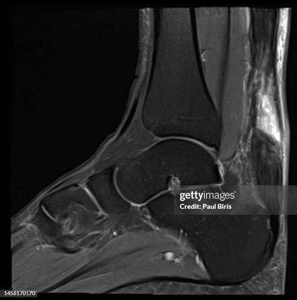 achilles tendinosis & achilles tendon rupture seen on mri sagittal view - achilles tendon stock-fotos und bilder