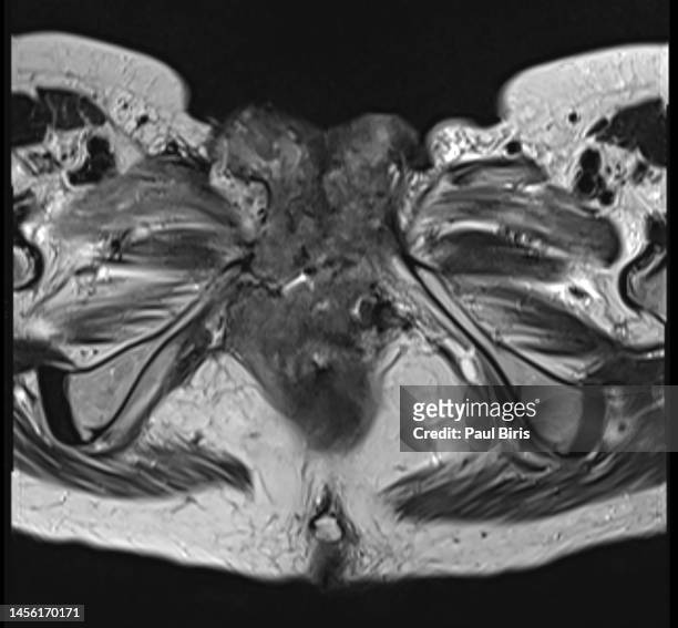 mri features of a aggressive perineal mass, axial t2 view - sistema reprodutor feminino imagens e fotografias de stock