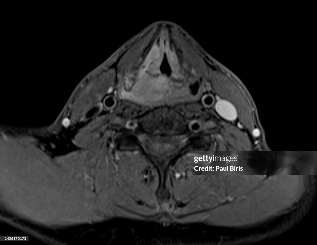 Squamous cell carcinoma (SCC) of the hypopharynx seen on right on MRI image