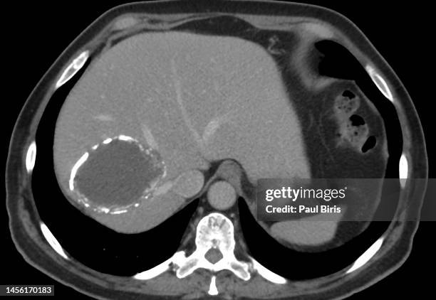 calcified hydatid cyst in the liver, seen on ct image (cat scan) - dog tapeworm stock-fotos und bilder