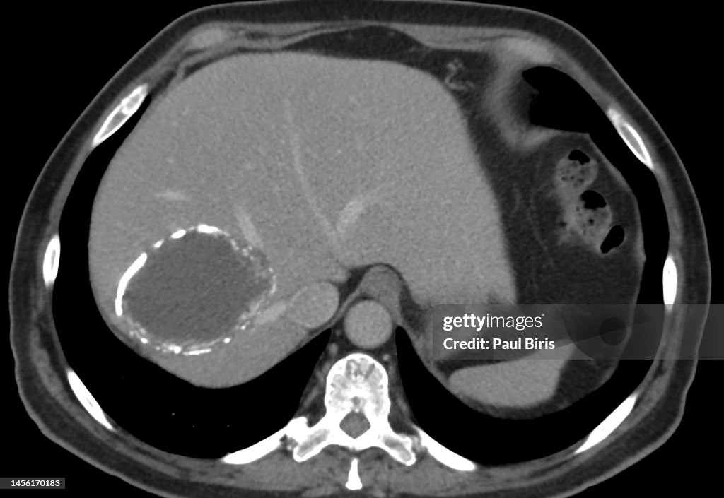 Calcified hydatid cyst in the liver, seen on CT image (CAT Scan)