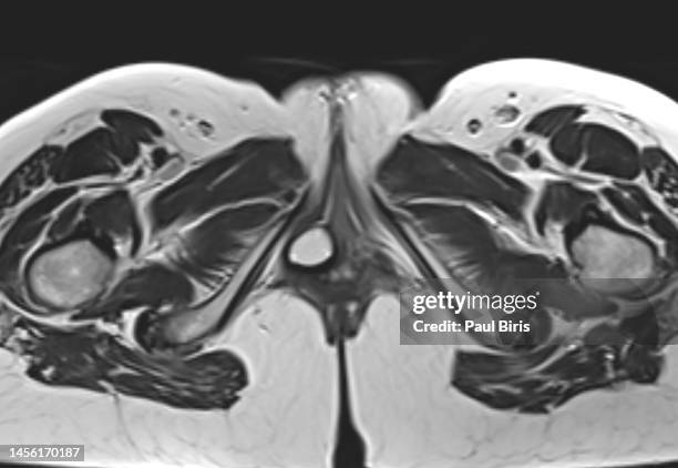 incidental right bartholin gland cysts identified on pelvic magnetic resonance imaging - cyst stock-fotos und bilder