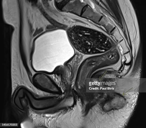 mr imaging evaluation of perianal fistulas - 3d scanning stock pictures, royalty-free photos & images