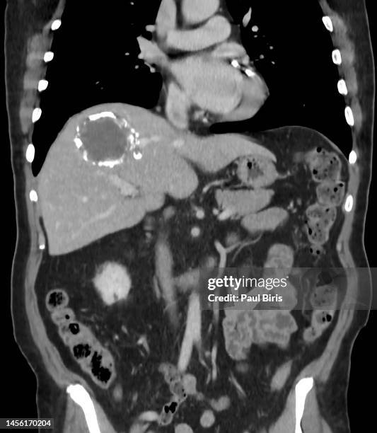 calcified hydatid cyst in the liver, seen on ct image (cat scan) - dog tapeworm stock pictures, royalty-free photos & images