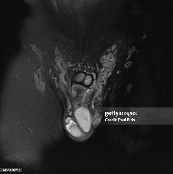 magnetic resonance imaging diagnosis for varicocele in male infertility patients - cancer de piel stockfoto's en -beelden