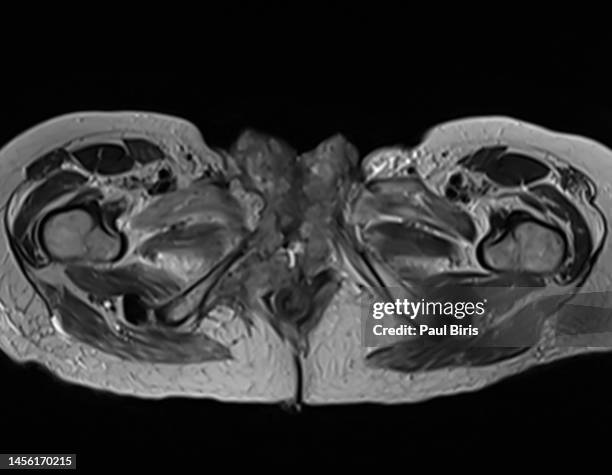 mri features of a aggressive perineal mass, axial t2 view - sistema reprodutor feminino imagens e fotografias de stock