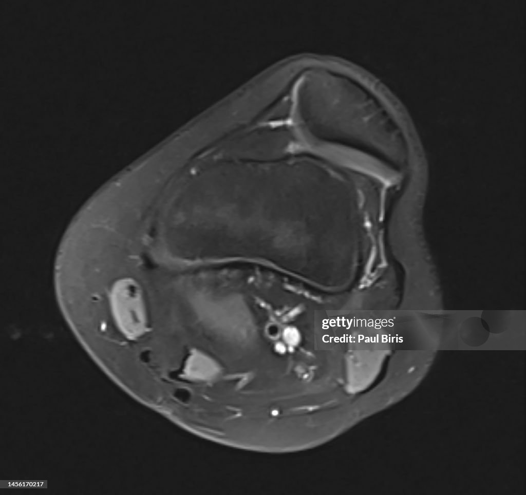 Lateral patellar dislocation at MR imaging