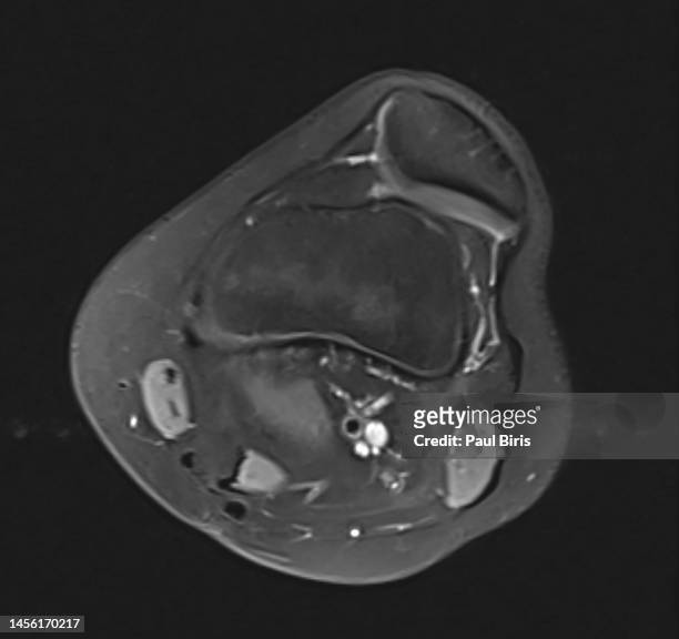 lateral patellar dislocation at mr imaging - rip science stock pictures, royalty-free photos & images