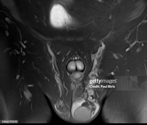 magnetic resonance imaging diagnosis for varicocele in male infertility patients - erectile dysfunction photos et images de collection