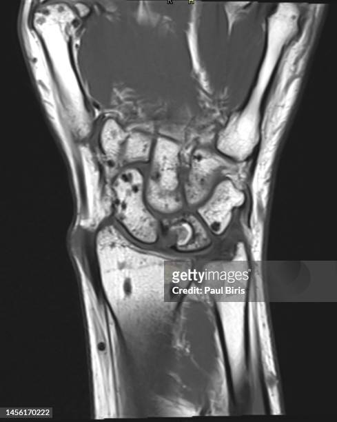 osteopoikilosis (opk) seen on mri t1  image of the hand - 橈骨 ストックフォトと画像