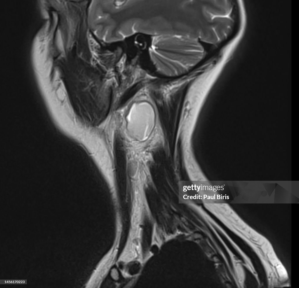 MRI findings of branchial cleft cysts (BCCs), sagittal T2 view