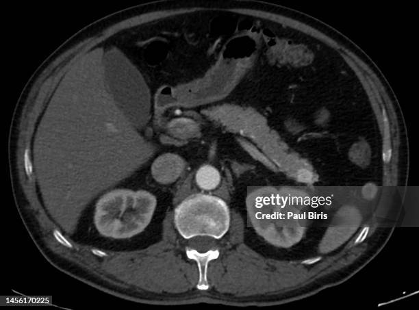 a case of occult insulinoma localized by pancreatic dynamic enhanced spiral ct - pancreatic cancer stockfoto's en -beelden