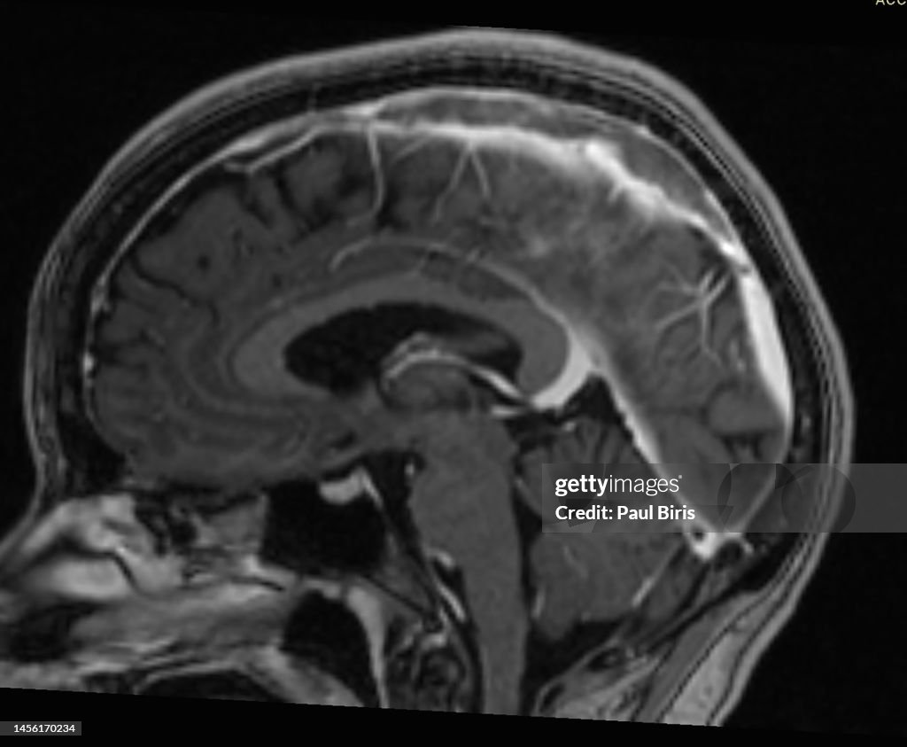 Superior sagittal sinus thrombosis (SSST) , MRI sagittal view