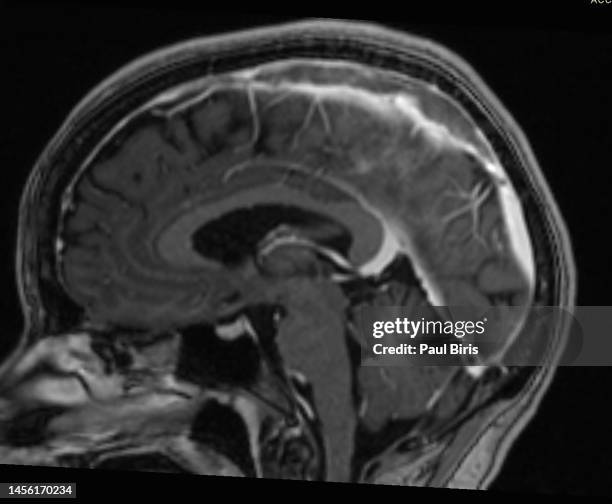 superior sagittal sinus thrombosis (ssst) , mri sagittal view - blodpropp bildbanksfoton och bilder