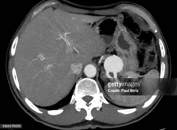 giant splenic artery aneurysm seen on mip reconstruction on ct image (cat scan) - aneurysm stock pictures, royalty-free photos & images
