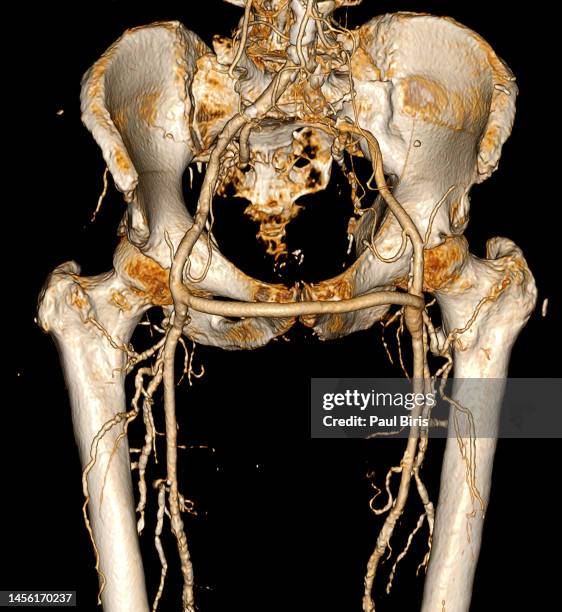 femorofemoral (femoral-femoral) bypass technique seen on 3d ct reconstruction - ct angiography stock pictures, royalty-free photos & images