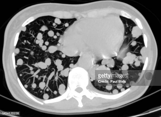 computed tomography ct scan showing malignant multiple cannonball pulmonary metastases - traquea fotografías e imágenes de stock