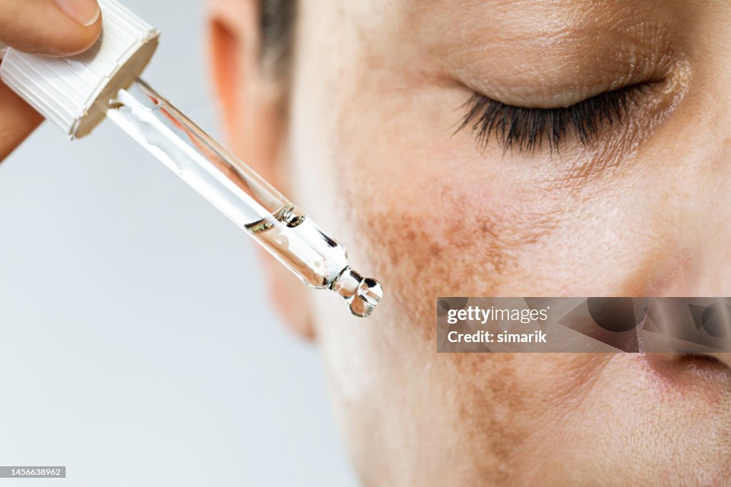 Hyperpigmentation