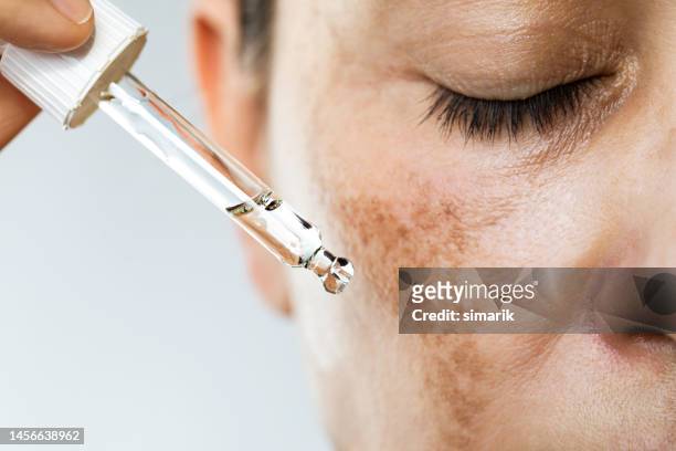 hyperpigmentation - skin stock pictures, royalty-free photos & images