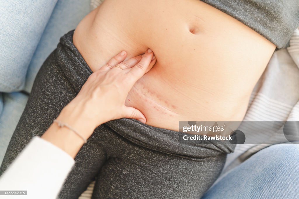 Cesarean wound treatment. postpartum concept.