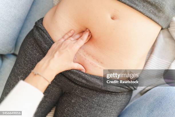 cesarean wound treatment. postpartum concept. - c section stock pictures, royalty-free photos & images