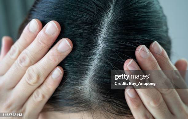 close up of dandruff problem on woman head. dandruff is a skin condition that causes itchy. - dandruff stock-fotos und bilder