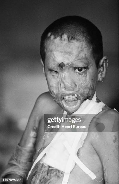 Enfant vietnamien hospitalisé qui a été gravement blessé pendant la guerre du Vietnam.