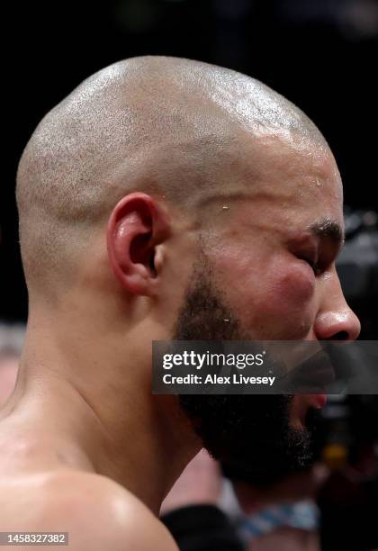 Detailed view of the bruised and swollen cheek and eye of Chris Eubank Jr following defeat to Liam Smith during the Middleweight fight between Chris...