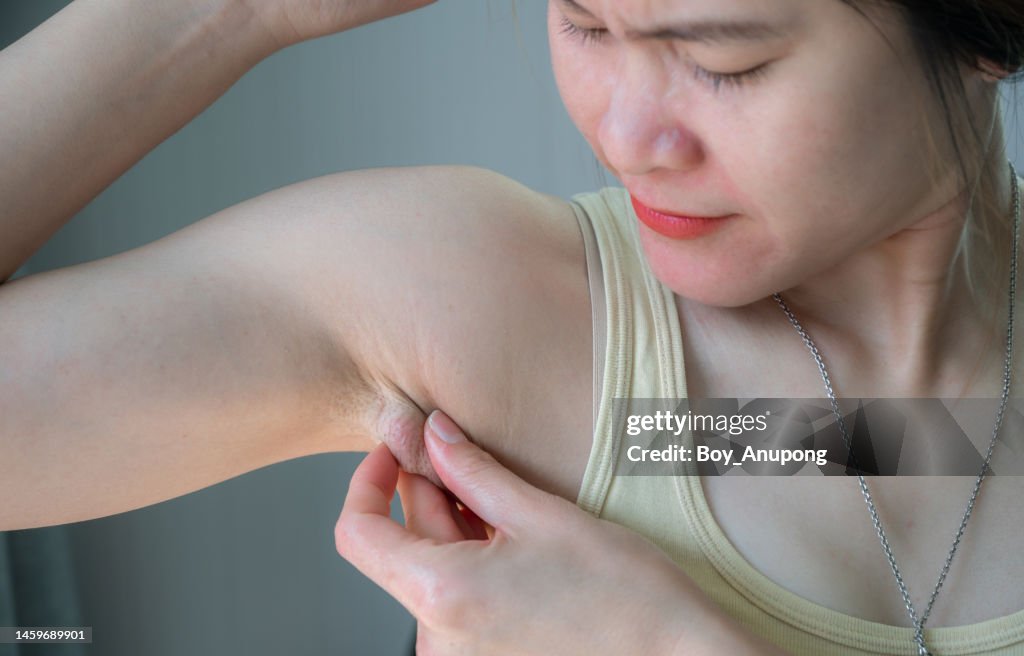 Close up of Asian woman having swollen axillary lymph nodes under her armpit.
