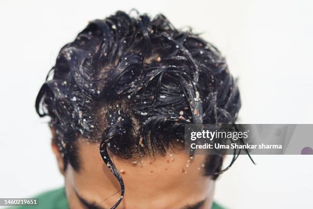 natural home remedies for hair fall - dandruff stock pictures, royalty-free photos & images