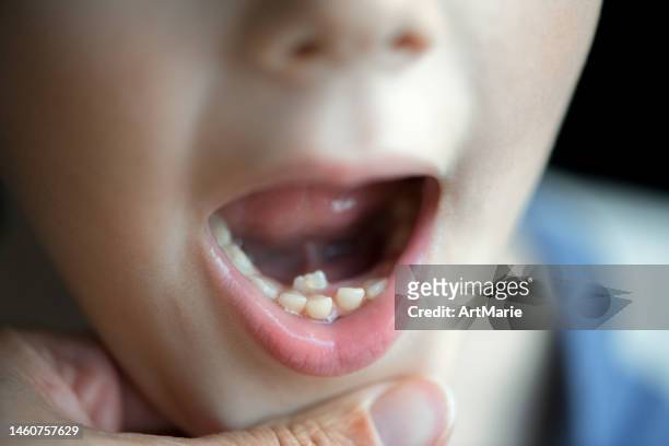 haifischzähne zahnproblem - neuer zahn wuchs hinter milchzähnen - shark teeth stock-fotos und bilder