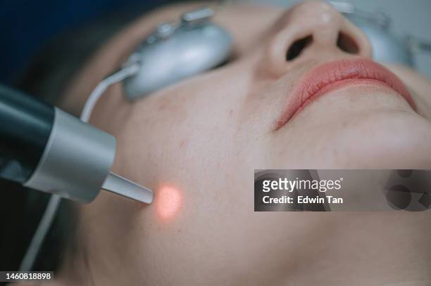 asian chinese male aesthetician laser ipl treatment on his female patient in clinic - haarvat stockfoto's en -beelden