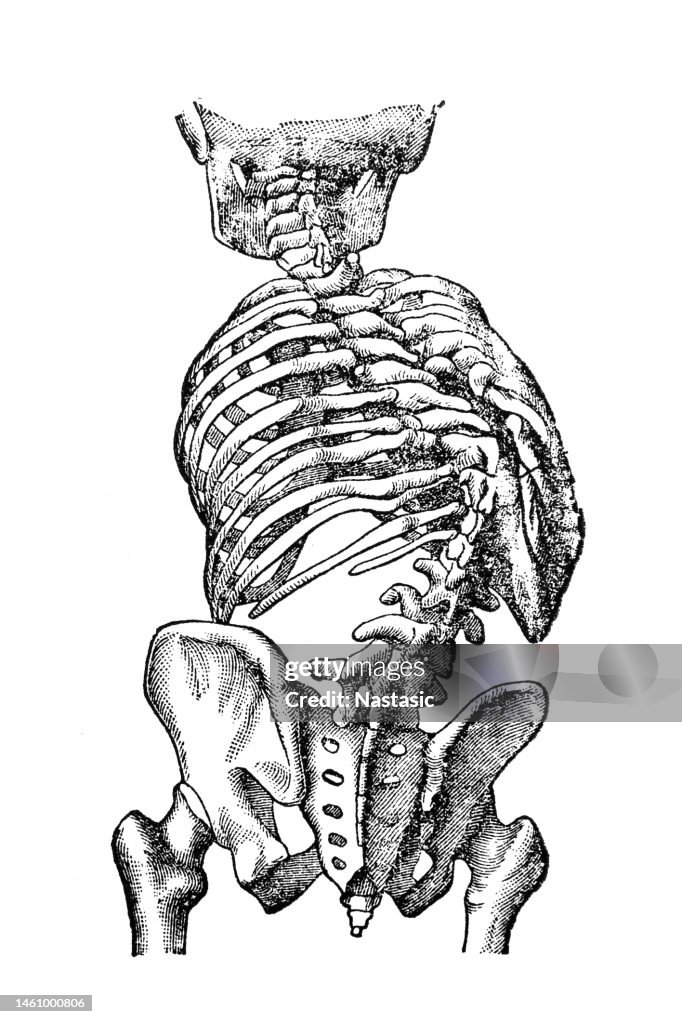 Spine degeneration