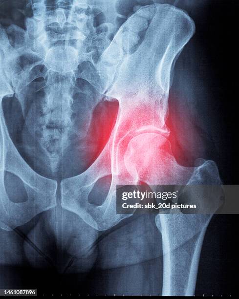 pelvis x-ray 01 - joint body part stock pictures, royalty-free photos & images