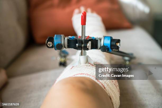 woman with external fixation right tibial fracture - human spine stock pictures, royalty-free photos & images