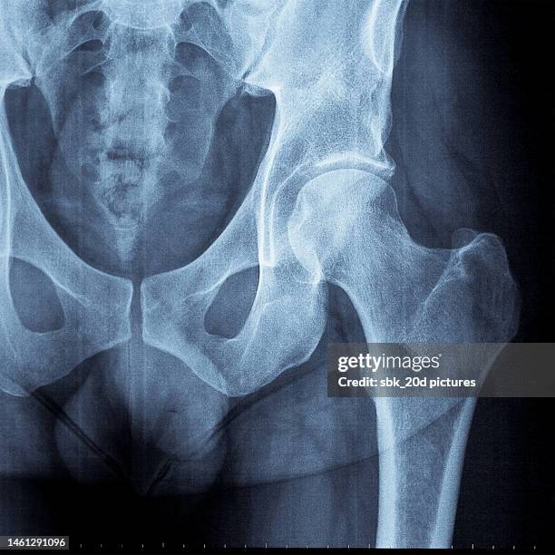 pelvis x-ray 09 - hips stock-fotos und bilder