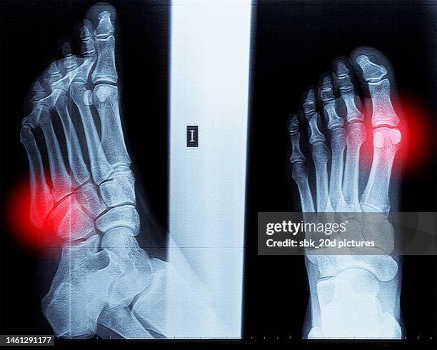 x-ray foot 05 - broken heel stock-fotos und bilder