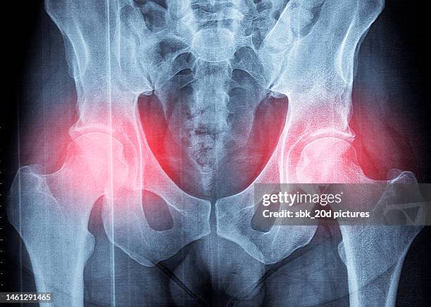 pelvis x-ray 03 - hüfte stock-fotos und bilder