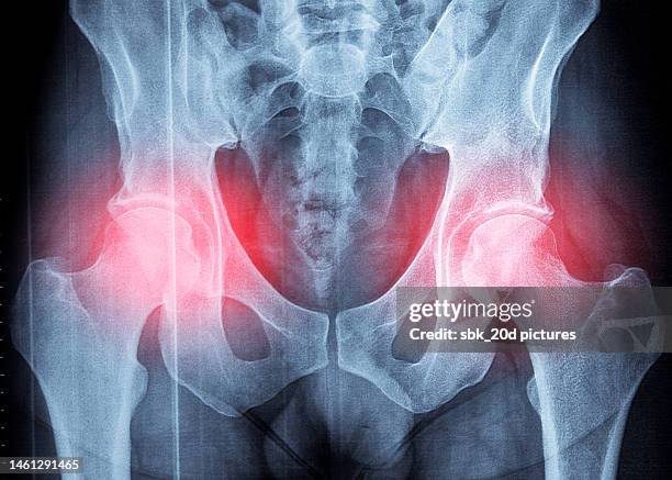 pelvis x-ray 03 - osteoporose - fotografias e filmes do acervo