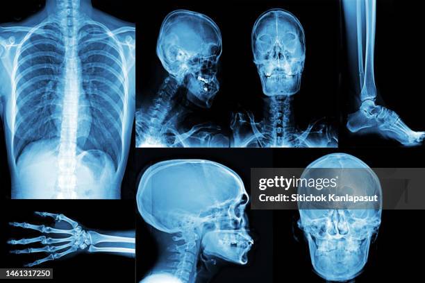 Nano-X Imaging: Cash Burn Makes It A Hold (NASDAQ:NNOX)