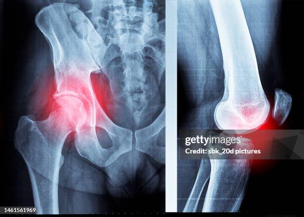 pelvis x-ray 04 - hip arthritis x ray stock pictures, royalty-free photos & images
