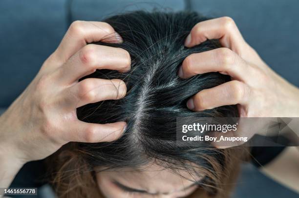 close up of dandruff problem on woman head. dandruff is a skin condition that causes itchy. - dandruff stock pictures, royalty-free photos & images