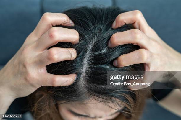 close up of dandruff problem on woman head. dandruff is a skin condition that causes itchy. - caspa - fotografias e filmes do acervo