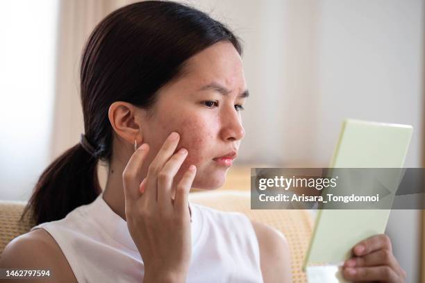 conceptual shot of acne & problem skin on female face. - skin care 個照片及圖片檔