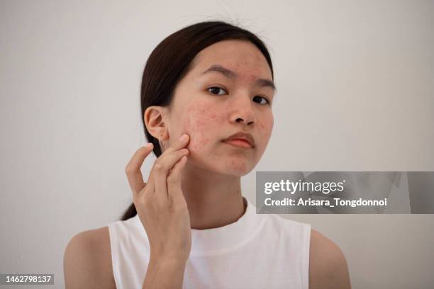 frau mit akne - acne stock-fotos und bilder